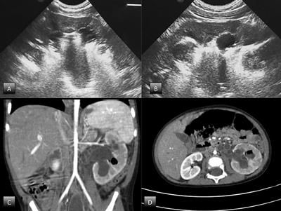Emphysematous Pyelonephritis Following Ureterovesical Reimplantation for Congenital Obstructive Megaureter. Pediatric Case Report and Review of the Literature